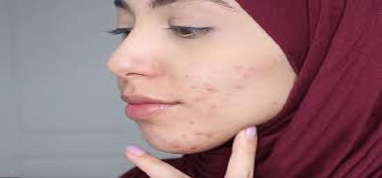 Atasi Wajah Berjerawat Dengan Buah-buahan Ini
